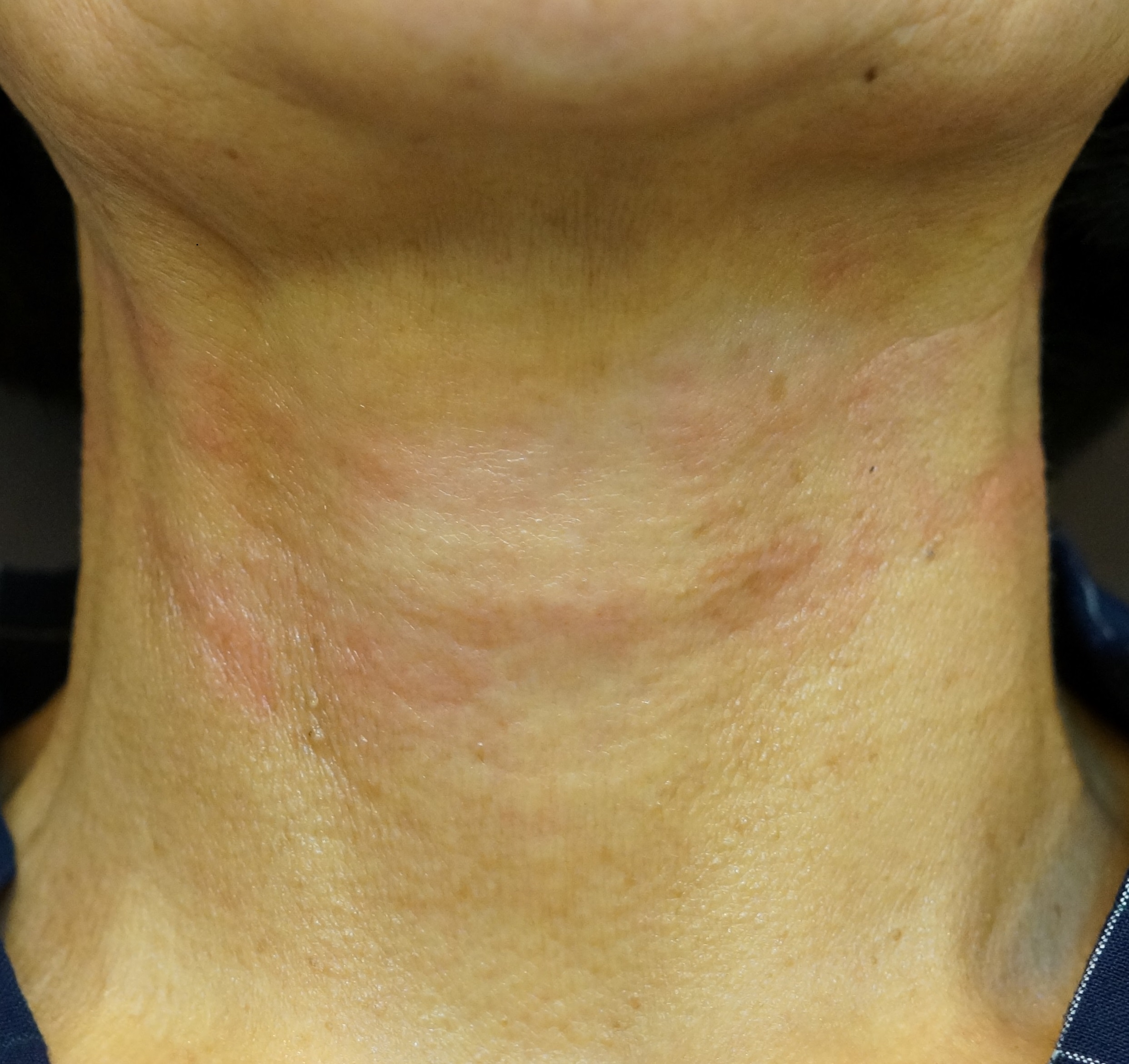 목주름 필러 After