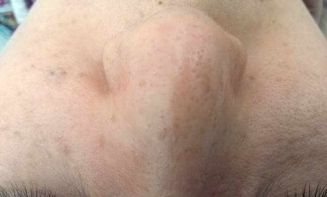 아피니트 코 블랙헤드 After