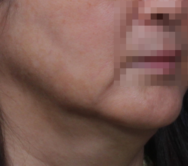 인모드 리프팅 After