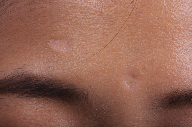 수두 흉터 Before