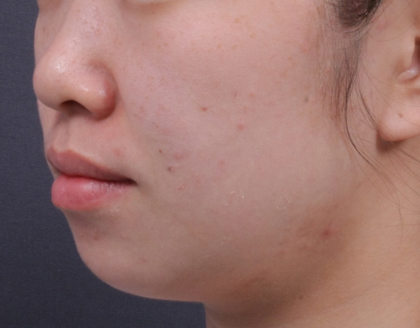 이중턱 쓱팻 시술 Before