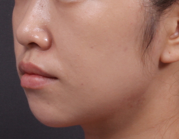 이중턱 쓱팻 시술 After