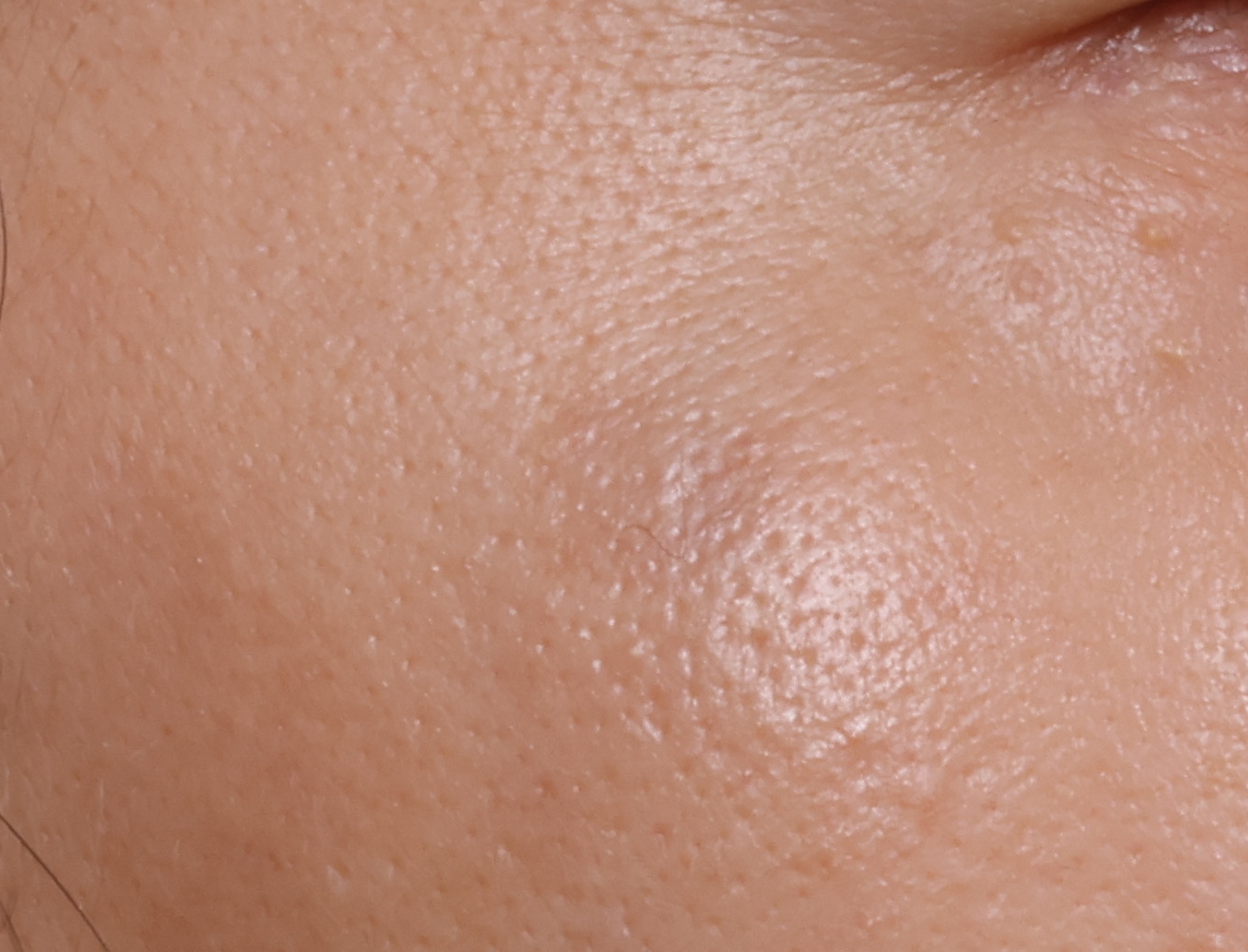 젠틀맥스프로플러스를 이용한 흑자 치료.. After