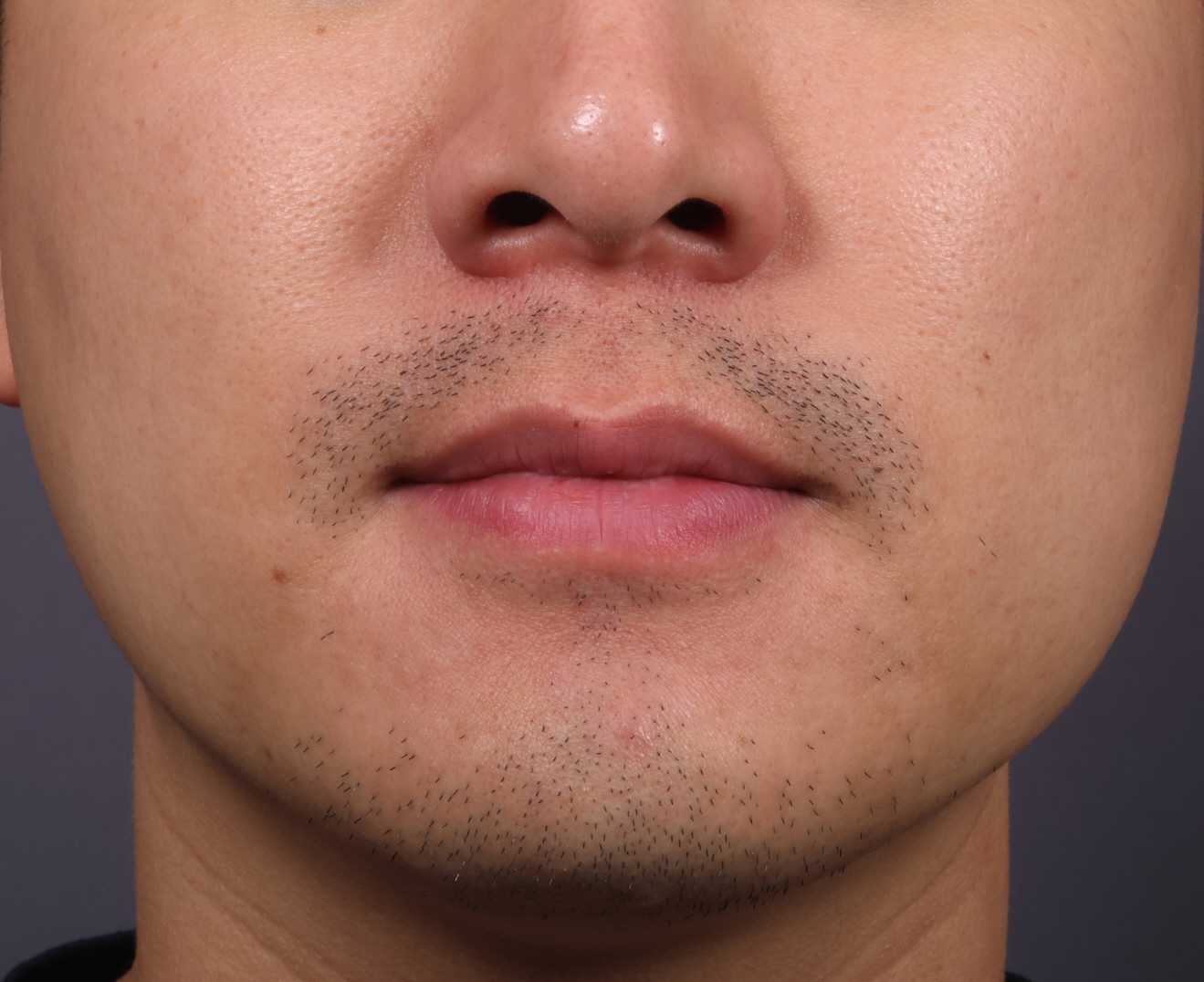 남성 인중 턱수염 제모 (젠틀맥스프로플러스).. Before