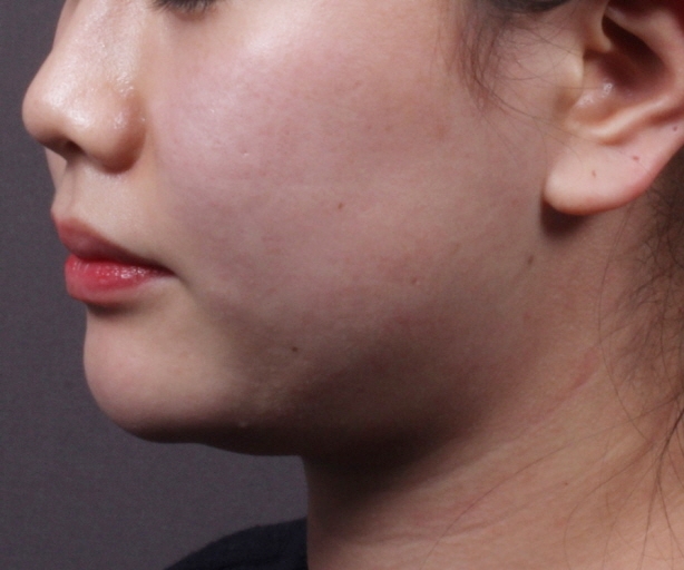 턱라인 실루엣소프트 리프팅 Before