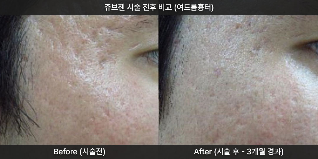 <font color="#000000"><strong style='font-weight:bold;'>쥬브젠 자가진피재생술, 깊은 주름과 흉터 치료..</strong></font>