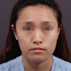 얼굴 전체 지방이식 Before