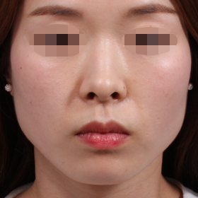 사각턱 보톡스 Before