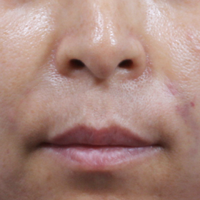 필러를 이용한 팔자 주름 교정 After