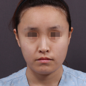 얼굴 전체 지방이식 After