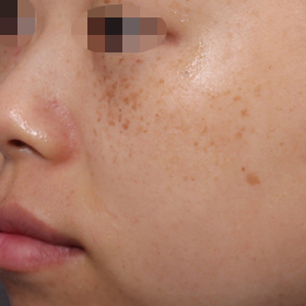 아리아 IPL을 이용한 색소 치료 Before