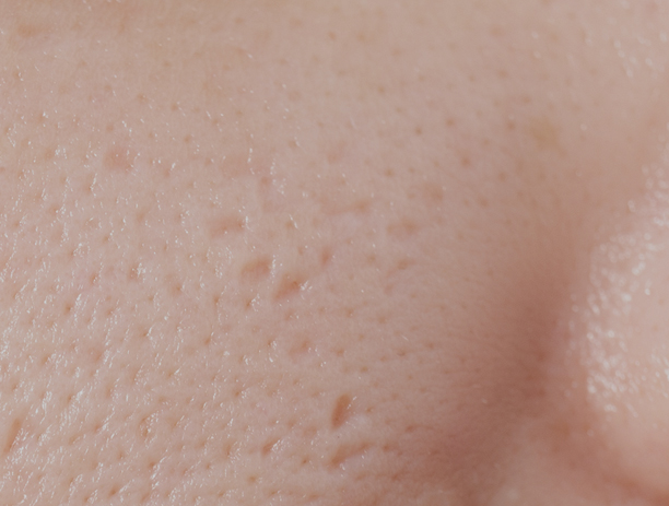 세인트클리닉 모공관리