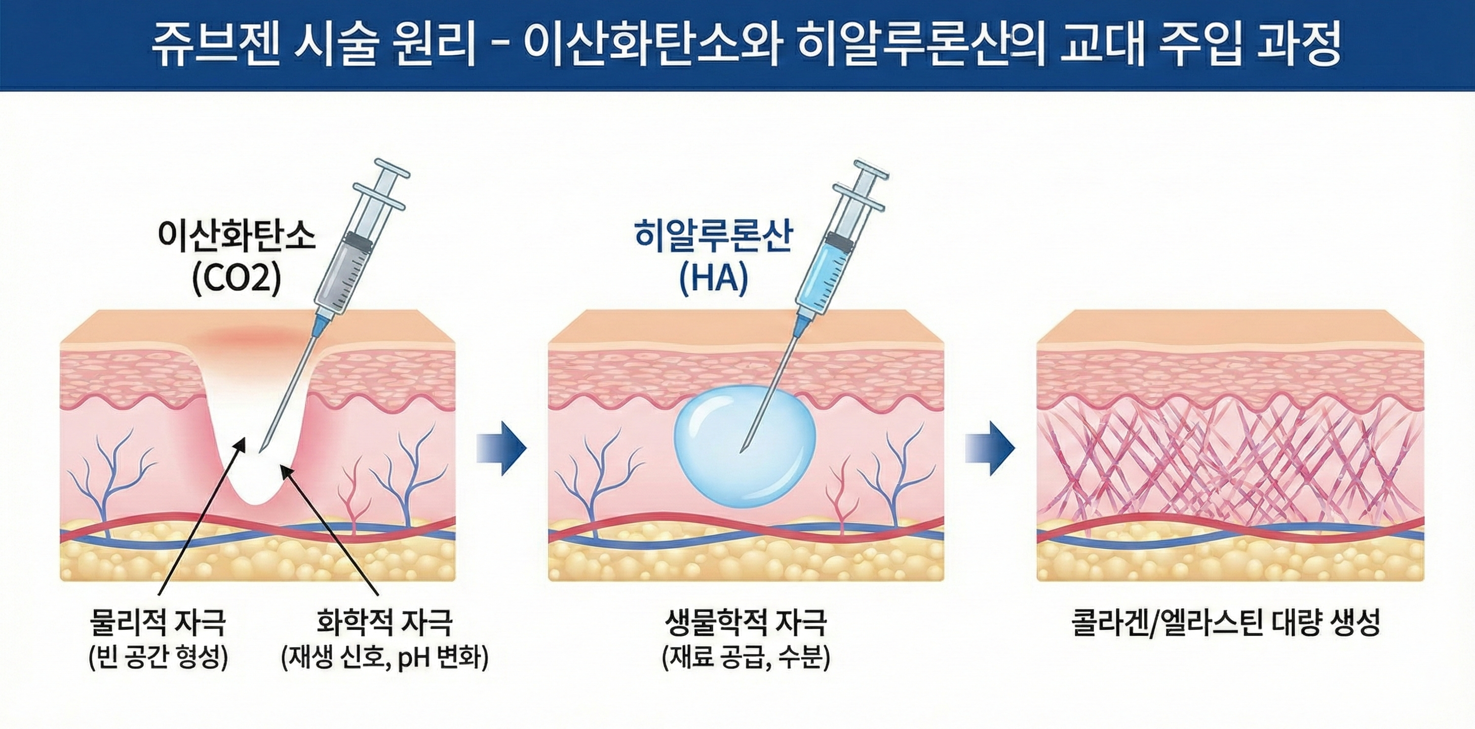 쥬브젠 자가진피재생술 원리