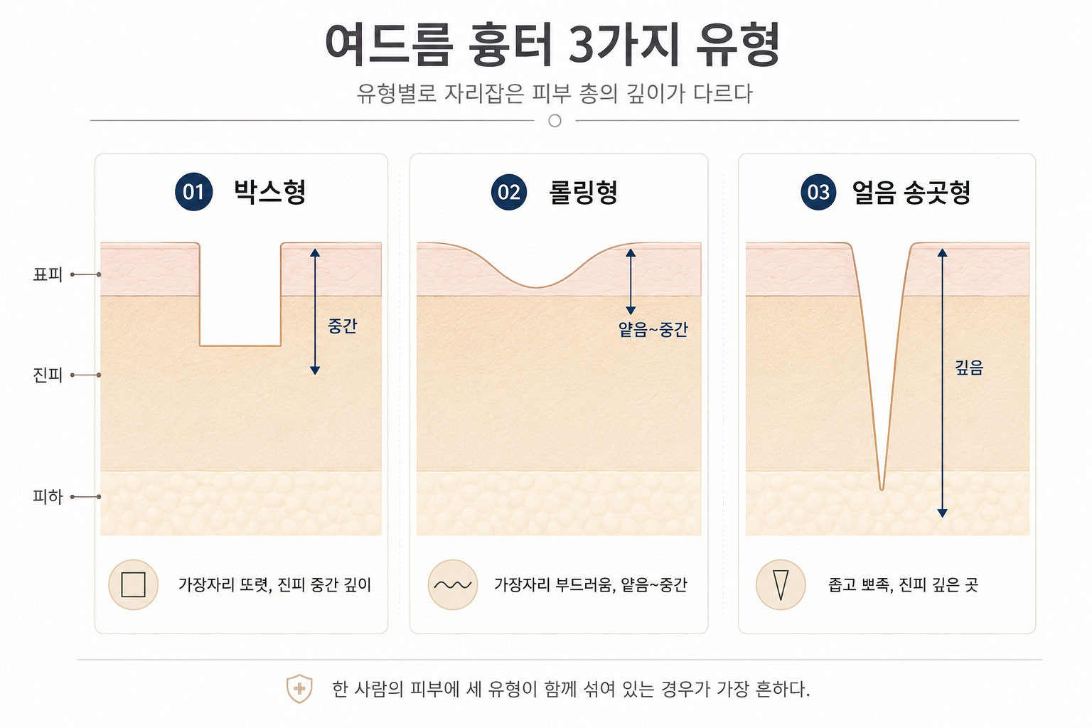 박스형·롤링형·얼음 송곳형 흉터 단면 비교