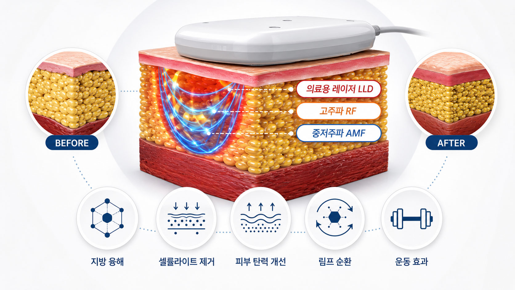 저출력 레이저·고주파·중저주파 작용 단면
